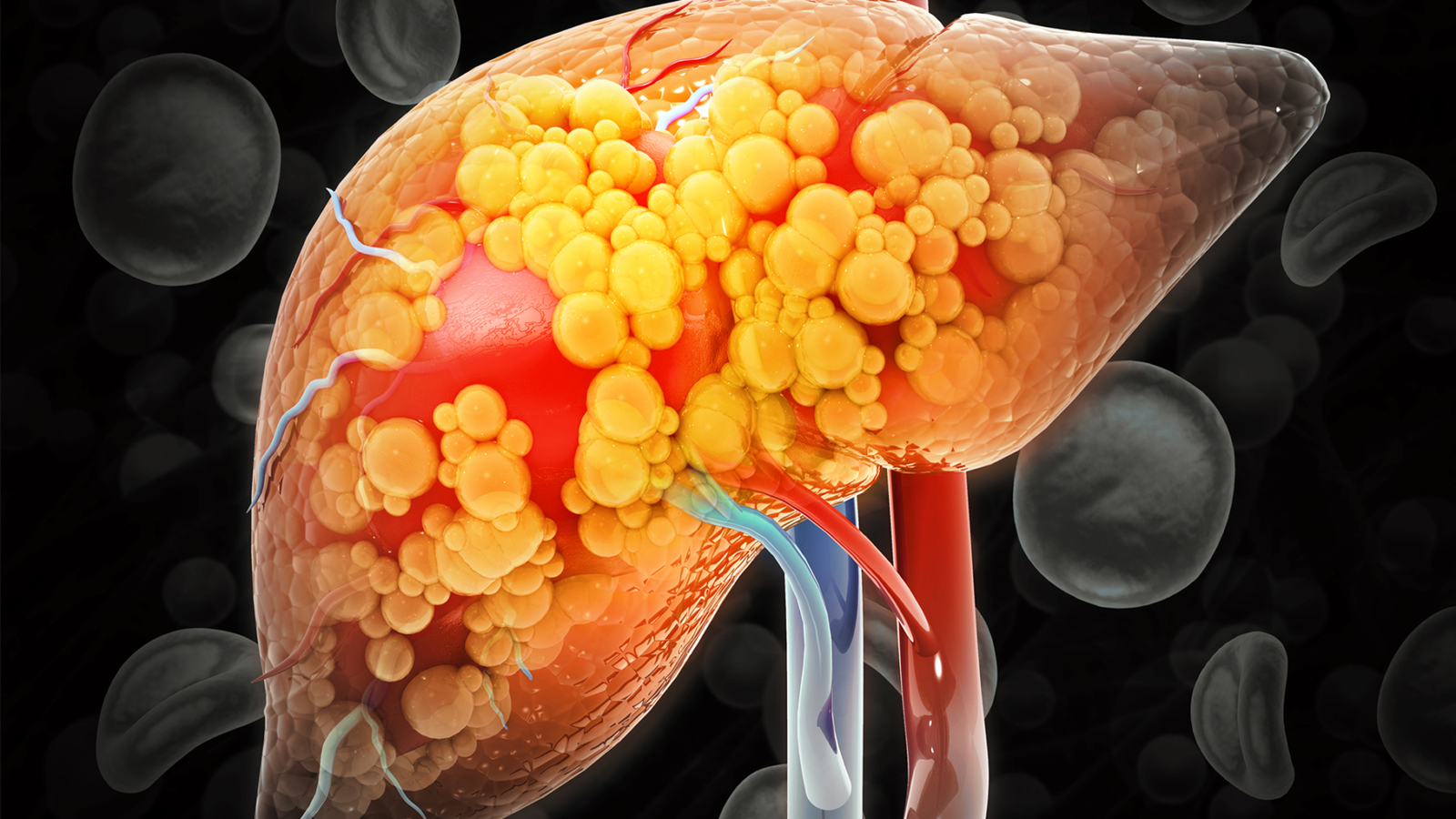 Groundbreaking Discovery Links Inherited Mutation to Fatty Liver Disease